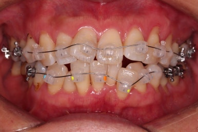 동래임플란트교정
