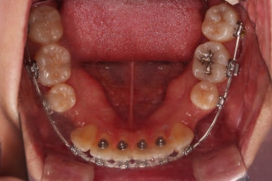 부산치아교정잘하는치과