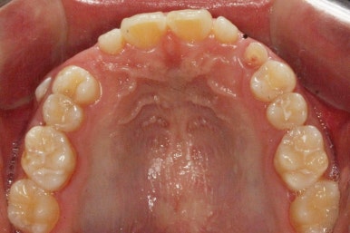부산왜소치교정