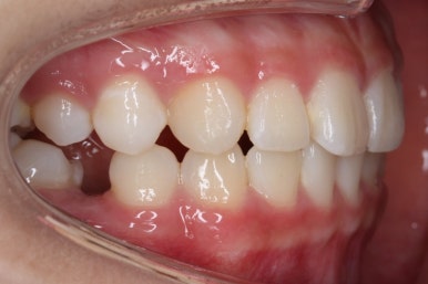 부산치아교정잘하는곳