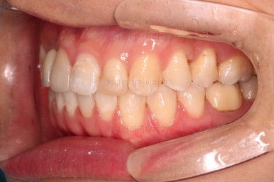 연산동치아교정