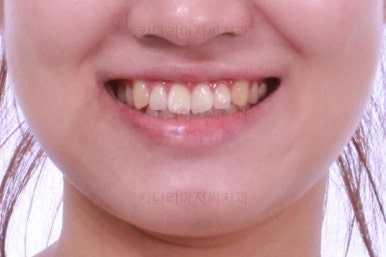 부산치아교정잘하는곳