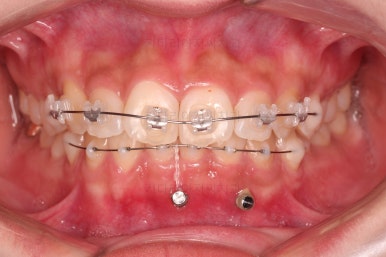 부산앞니부분교정