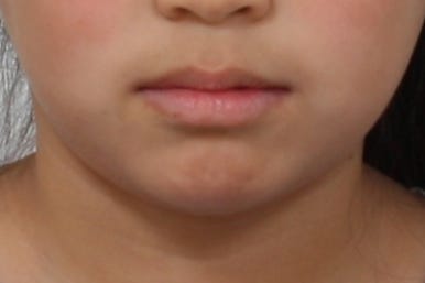 연산동덧니교정