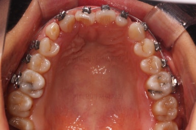 부산구순구개열