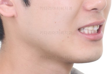 연산동치아교정