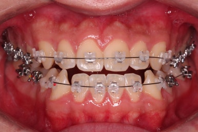 부산주걱턱교정