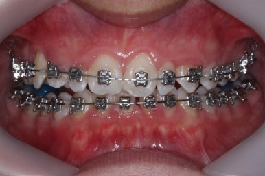 부산왜소치교정