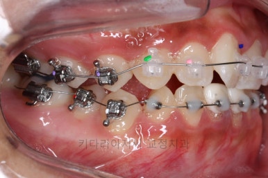 연산동치아교정