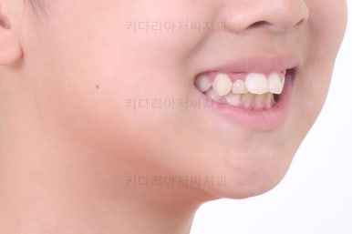 부산토끼치아교정