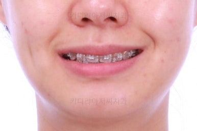 부산치아교정잘하는치과