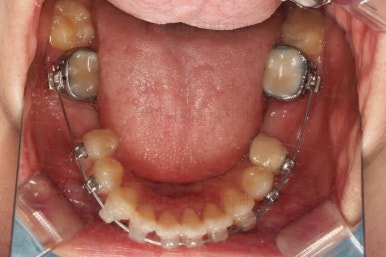 부산사랑니교정