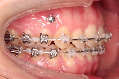 부산긴얼굴긴턱교정