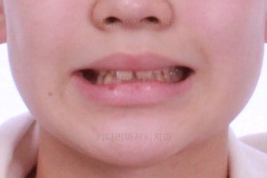 부산연산동치아교정