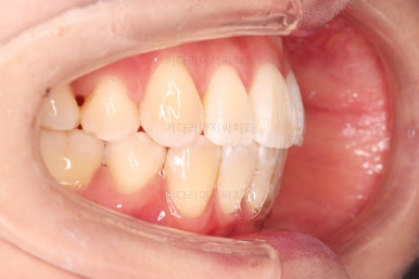 부산치아교정잘하는치과