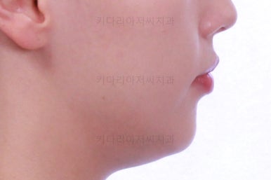 부산비대칭교정