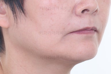 부산옥니교정