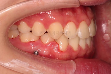 부산주걱턱교정