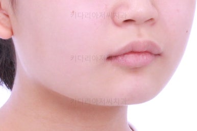 부산어린이치아교정