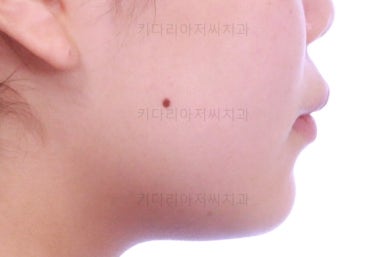 부산앞니벌어짐교정