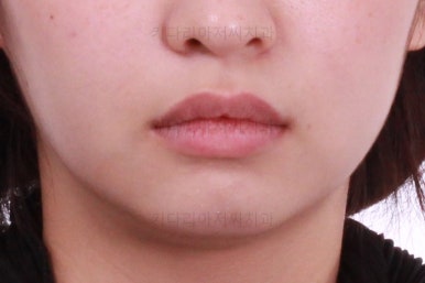 부산돌출입교정