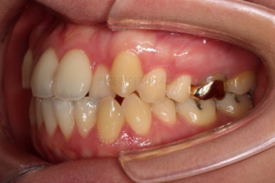 부산치아교정잘하는곳