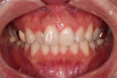 부산부분치아교정