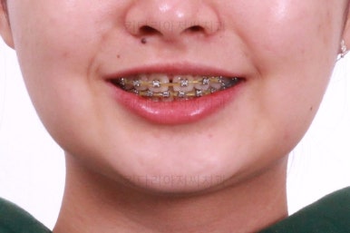 부산치아교정치과