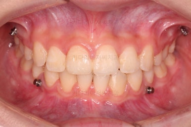 연산동치아교정