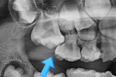 부산어린이치아교정