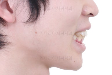 부산돌출입교정