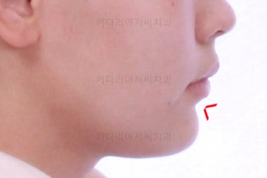 부산연산동치아교정