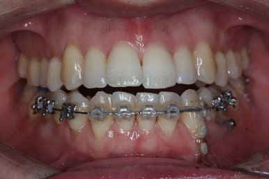 부산비수술교정