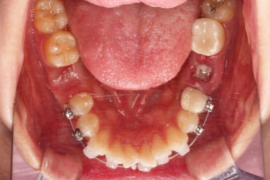 부산사랑니교정