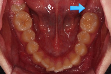 부산연산동사랑니발치