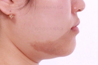 부산치아교정잘하는곳