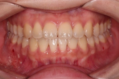 부산치아교정추천