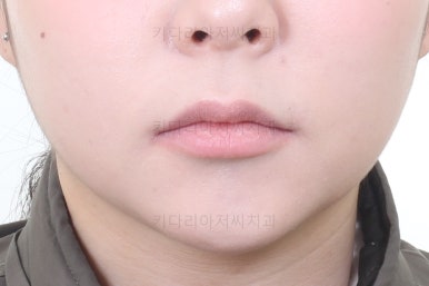 부산연산동교정치과