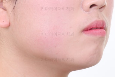 부산비발치교정