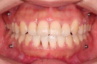 부산비발치교정