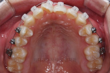 연산동치아교정