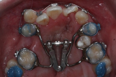 부산구순구개열