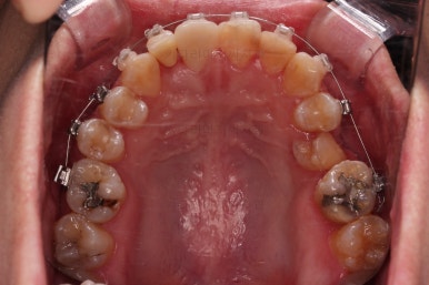 연산동치아교정