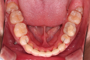 부산청소년치아교정