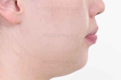 부산비대칭교정