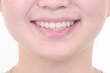 부산치아교정잘하는곳