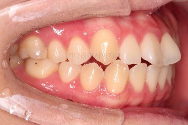 부산치아교정잘하는곳