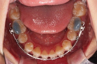 연산동치아교정