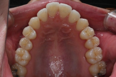 부산비수술교정