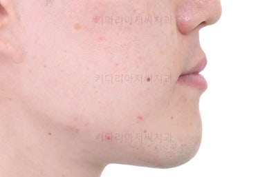 부산비수술교정